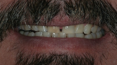 Smile with gaps between teeth