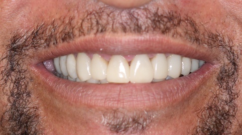 Full and healthy smile after dental treatment