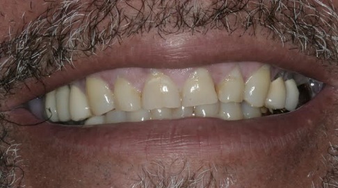 Worn and yellowed teeth before dental treatment