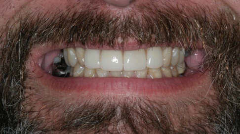 Closeup of smile before dental treatment