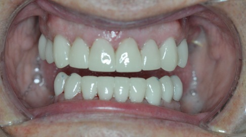 Flawless healthy smile after advanced dental restoration