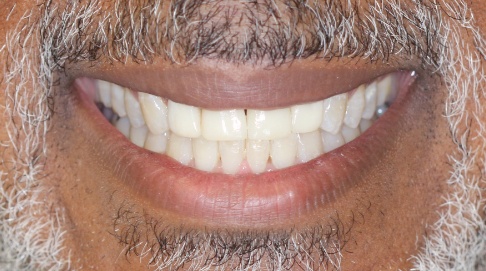 Restored top front teeth