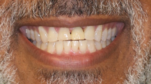 Damaged top front teeth