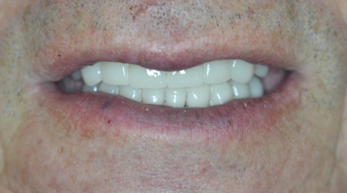 Healthy flawlessly repaired smile