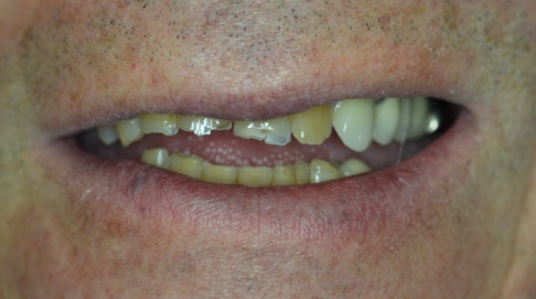 Severly damaged and worn teeth