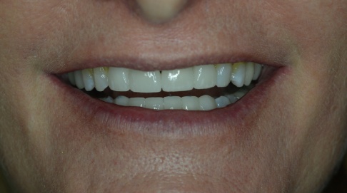 Bright healthy smile after cosmetic dentistry