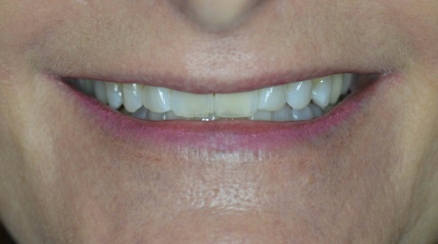 Discolored smile before cosmetic dentistry