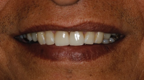 Healthy white smile around dental treatment