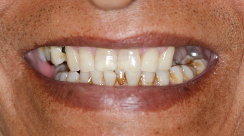 Dark discoloration around the gum line