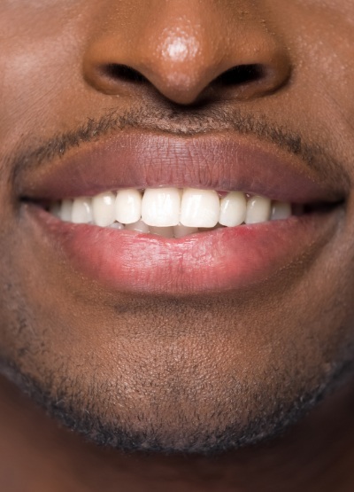 Closeup of patient after smile makeover