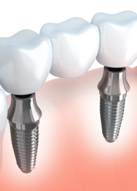 Animated smile after dental implant supported fixed bridge