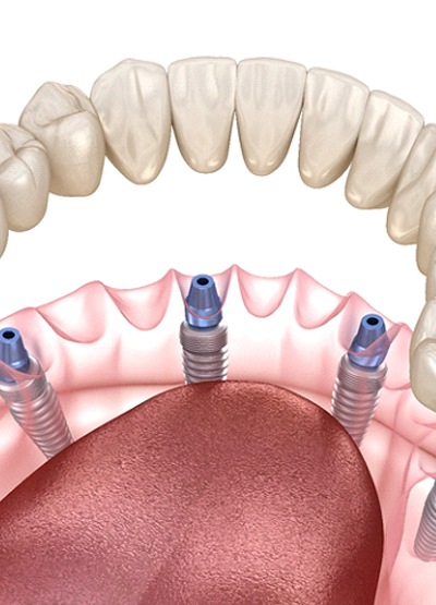 Implant dentures in Conroe