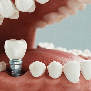 Diagram showing dental implant placement surgery in Conroe