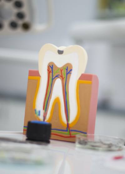 Model tooth and gums to demonstrate scaling and root planing