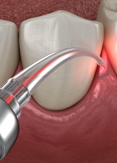 Animated smile during soft tissue laser dentistry treatment